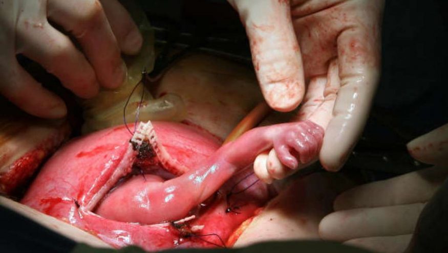 Fetal Cerrahi (Anne Karnında Ameliyat)